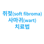 쥐젖(soft fibroma) 치료법