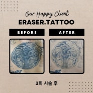 문신제거 타투제거 달인 이레이저타투 eraser.tattoo