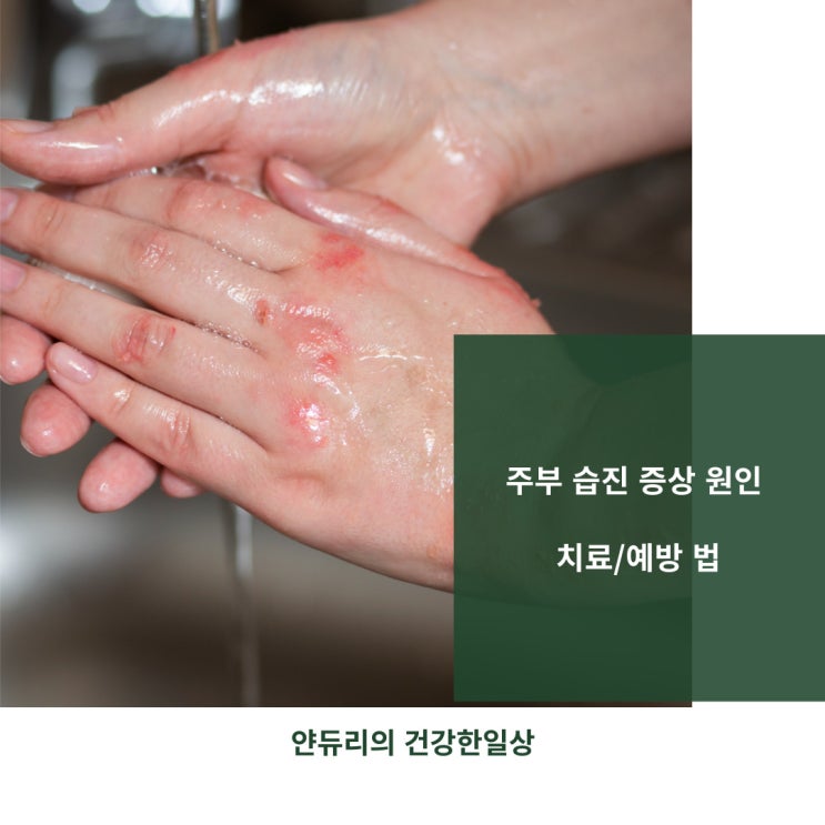 주부 습진 증상 원인 치료방법과 예방법 : 네이버 블로그