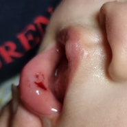 [행복한만남-육아] 놀다 넘어지면서 아랫 입술 다친 16개월 아기