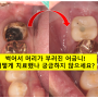 신경치료한 치아 부러짐! 뼈이식 하면서 임플란트 수술하는 과정/기간/비용. 행당역 임플란트 치과.