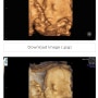 [호주 임신/출산] 20주차 3D 초음파 얼굴공개, 비용