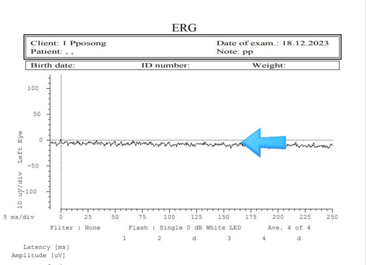 녹내장 환자의 ERG 검사 케이스 입니다. : 네이버 블로그