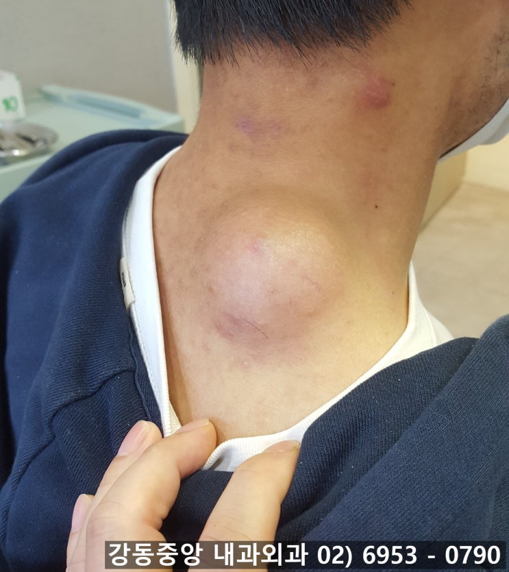 피지낭종 핀홀법 제거 수술 외과? 성형외과? (천보성 외과) : 네이버 블로그