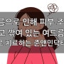 송파구 가락동 여드름 흉터치료, 프락셀레이저+콜라겐부스터 쥬베룩