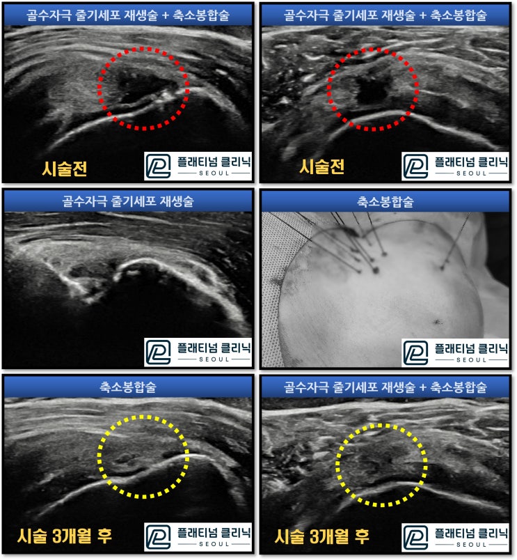 (플래티넘의원) 회전근개 파열. 비수술적 방법으로 치료가 가능할까?