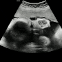 [임신32주차 5일] 9개월 초음파, 백일해 접종, 역아 둔위 교정운동