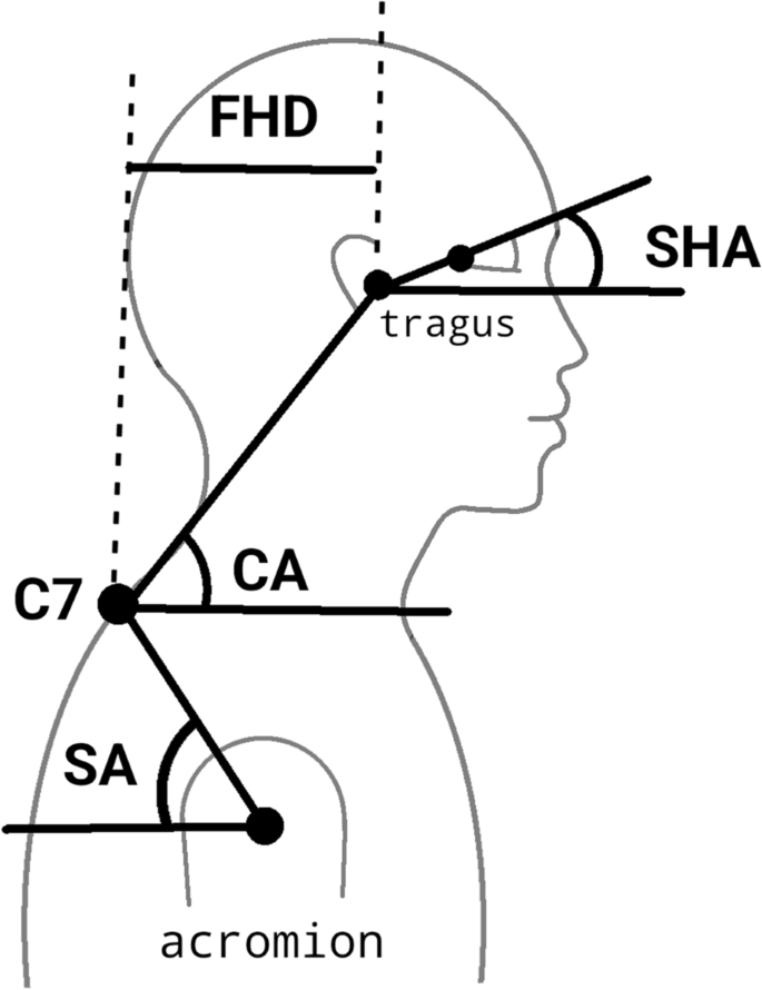 수원pt, 체형분석 - FHP(Forward Head Posture) 거북목이란? (1) : 네이버 블로그