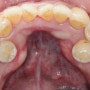 [논현역 치과] 과잉치? 치아 갯수가 많은 증상?