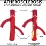 죽상경화증(Atherosclerosis) 진단기준