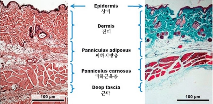 지방층염 (Panniculitis) : 네이버 블로그