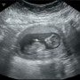 [임신12주] 1차기형아검사 + 목투명대검사