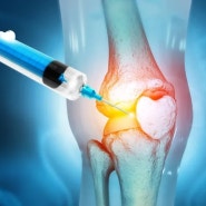 무릎 퇴행성관절염, 이제 수술없이 주사치료로 해결하세요!_자가골수 줄기세포 치료(BMAC)