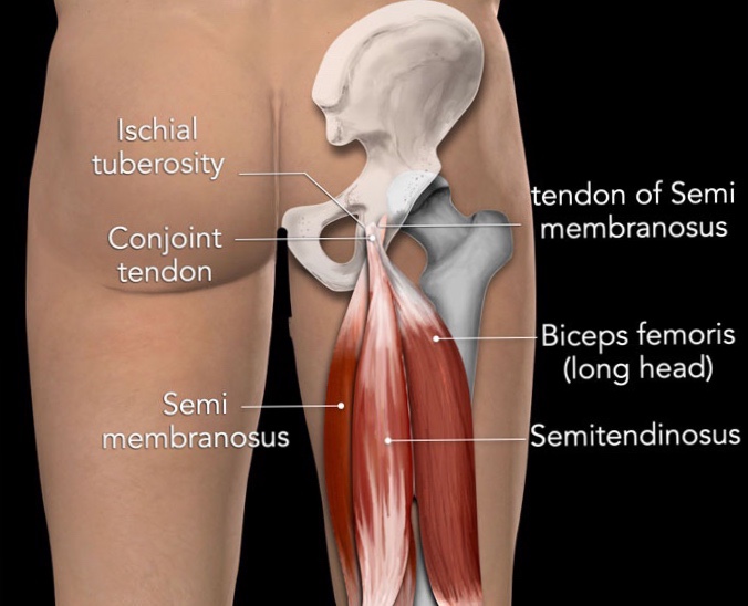 화순 헬스장 근위부 햄스트링 손상 Proximal Hamstring injury ) : 네이버 블로그