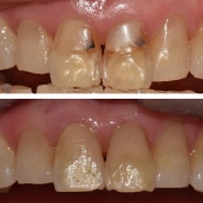 앞니 심미 레진치료 [월곡역치과 서울바른닥터치과]