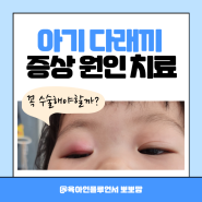 아기 다래끼 돌아기 콩다래끼 원인 증상 치료법 전염 수술해야할까