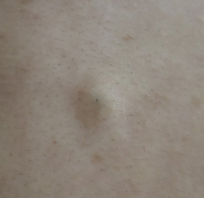 등에 생긴 멍울? 등 표피낭종 수술 1~3일차 : 네이버 블로그