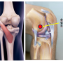 무릎 뒤쪽 통증, 오금통증 6가지 원인과 슬와근 치료[천안.아산. 달천한의원]