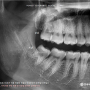 인천 사랑니 치과 발치하기 어렵다고 들었던 뿌리 휜 매복사랑니 제거