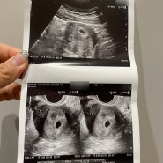 Ep15. 감자배아 아기집 발견 임신 4주차 출혈 임신 5주차