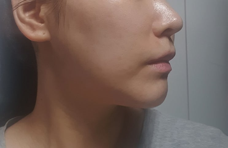 사각턱 `측두근 보톡스+이것` 모르면 부작용 납니다. 후기 : 네이버 블로그