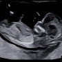 [임신] 12주차 태아목투명대 검사(다운증후군 검사)
