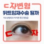 [칼럼] 뒤트임재수술 ㄷ자 눈꼬리 변형 잡아줄까
