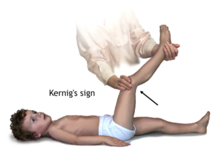 Kernig Sign 커니그 사인 뇌수막염 검사 : 네이버 블로그