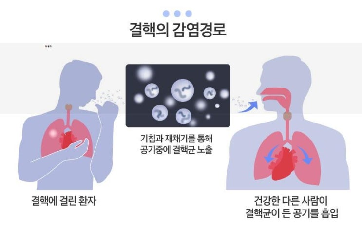 폐결핵 폐결핵 증상 점검하기 : 네이버 블로그