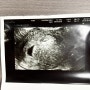 임신 초기 일기 ~5주 6주 7주 8주(단축근무/임밍아웃/갑상선기능저하증)