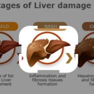 비알코올성지방간염 연구