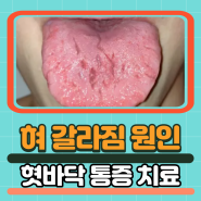혀 갈라짐 원인 혓바닥 갈라짐 통증 치료
