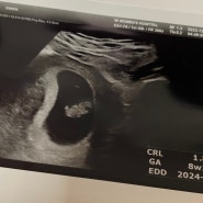 임신 8주 초음파 젤리곰 산전검사 더블유여성병원