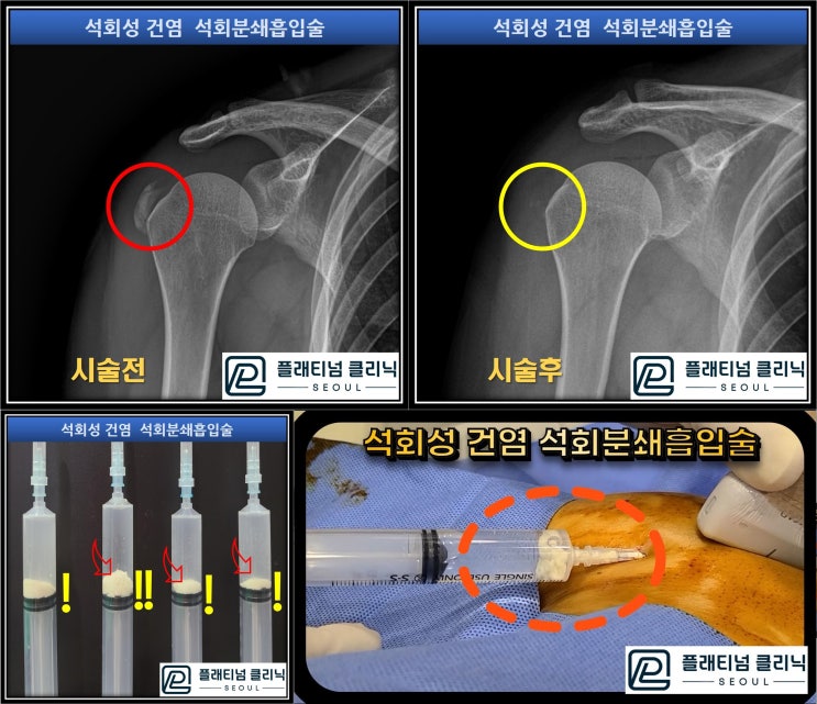 (플래티넘의원) 어깨 석회성 건염. 극심한 통증에서 벗어나는 방법. 석회분쇄흡입술(비수술적 석회제거술)