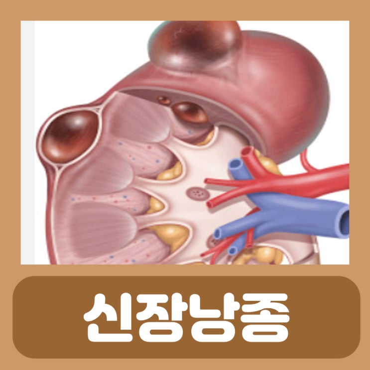 신장에 물혹 신장낭종 신장 콩팥 물혹 : 네이버 블로그