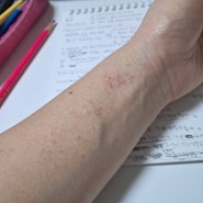 접촉성피부염 원인과 치료 ; 자극성접촉피부염, 알레르기성접촉피부염 ; 가죽알레르기피부염치료기