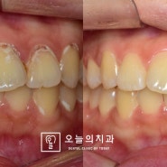 부천 치과 잘하는 곳 에서 3일에 걸쳐 완성된 꼼꼼한 레진치료 과정.