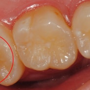 [청주 가경동 치과 치과다움] 충전된 레진 옆 변색 치료, 이차 우식