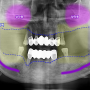 월성동 치과 염증은 치아를 탈락시킬 수 있습니다. (빈 자리에 임플란트 를 식립)