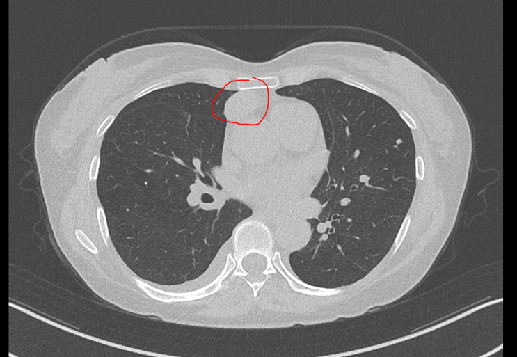 [흉선암] 엑스레이에서 보이지 않은 흉선암(Thymic carcinoma) : 네이버 블로그