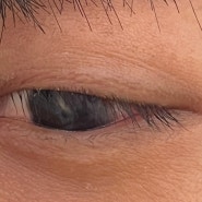 눈높이안과: 각막타투(각막문신) 사례 (뉴질랜드 30세 환자)