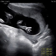 임신 15주차 두콩이 초음파 사진