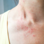 목걸이 반지 금속 알레르기 알러지 쇳독 쇠독 증상, 예방, 검사 및 치료법은 ?