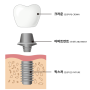 신월동임플란트, 크라운이 빠졌어요!