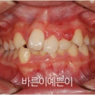 삐뚤삐뚤 치아 크라우딩 과개교합 발치 교정 사례