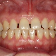 중년 치아교정, 벌어진 치아 교정치료.