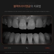 티유치과 4월 매거진, 블랙트라이앵글 치아의 치료법 [TU치과]