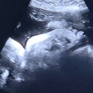 [임신 37주-38주] 용인 세브란스 산부인과 첫 내진 과 두번째 태동검사