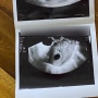 임신 6주 차 초음파