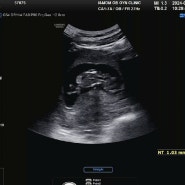 설복맘 임신일기 : 1차 기형아검사 (11주차 4일)